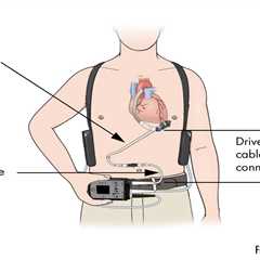 FDA Broadcasts Recall of Coronary heart Pumps Linked to Deaths and Accidents